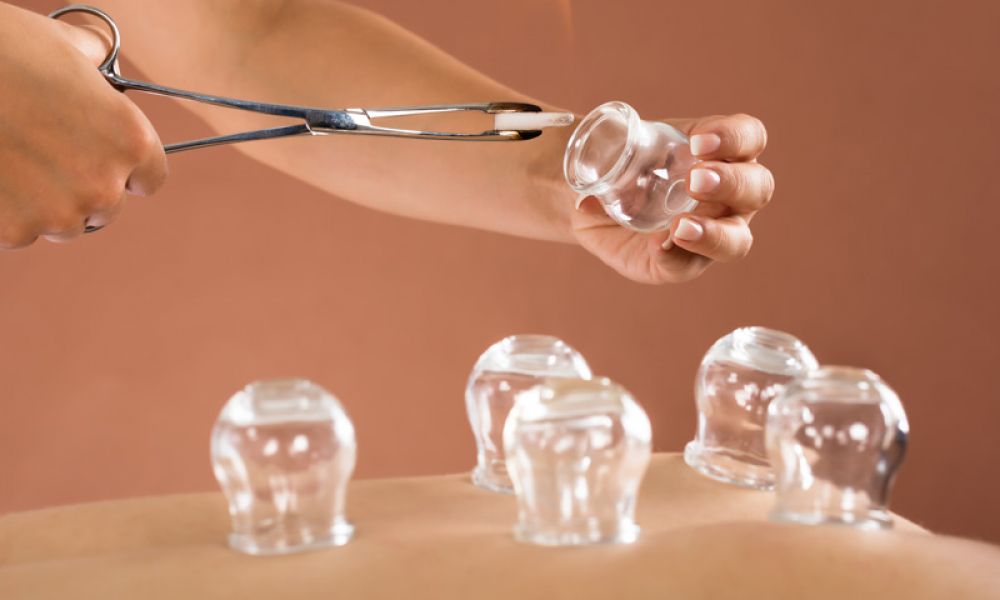 SinoQi TCM Zürich - Schröpfen